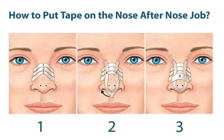 rhinoplasty